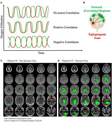 Seizure Freedom After Epilepsy Surgery and Higher Baseline Cognition May Be Associated With a Negatively Correlated Epilepsy Network in Temporal Lobe Epilepsy